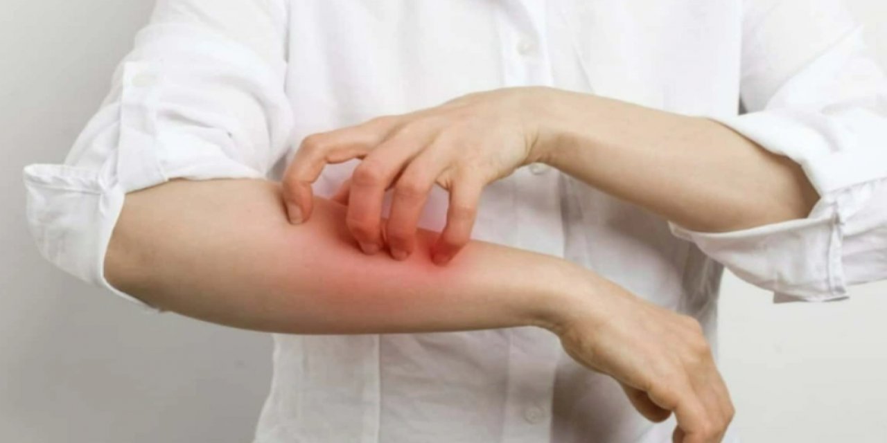 Hatay'da bir okulda 70 öğrencide uyuz tespit edildi: Çocuklar duş alamıyor