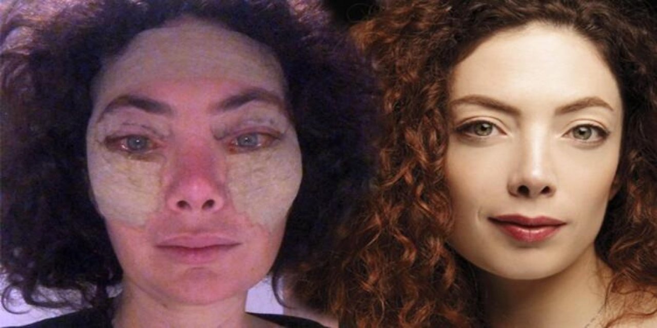 Ünlü oyuncudan estetik itirafı! Bu acıyı bilsem yaptırmazdım...
