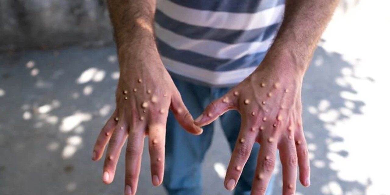 Ankara'da Maymun Çiçeği karantinası