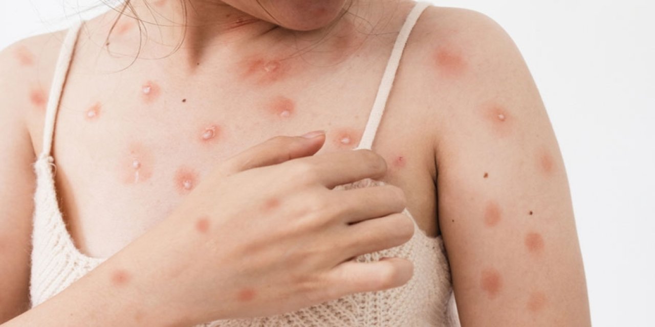 Sağlık Bakanlığı'ndan açıklama geldi: Ankara'da maymun çiçeği karantinası mı?