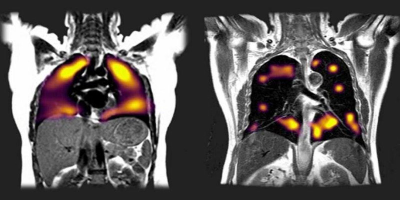 Oxford Üniversitesi açıkladı... İşte koronavirüsün ciğerlere verdiği zarar!