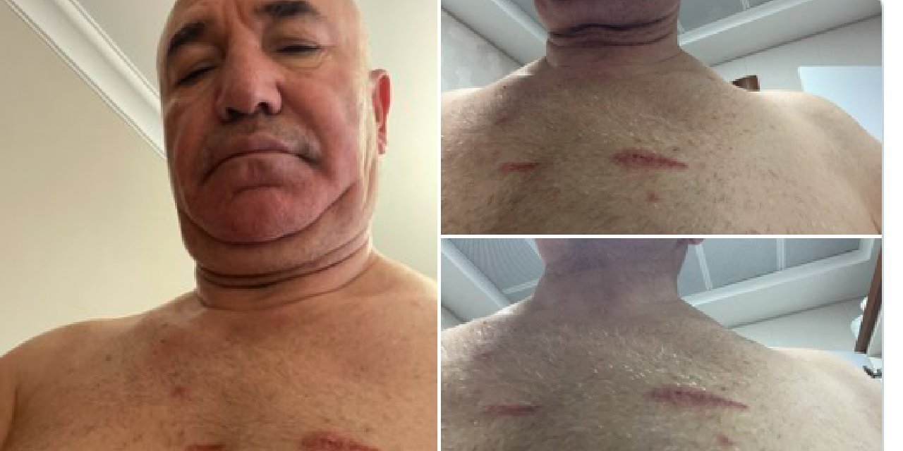 CHP milletvekili Mahmut Tanal polis müdahalesinde yaralandı: 'Açıkça suç işliyorlar'