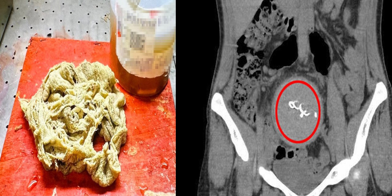 Doğumda karnında unutulan beze 2 yıl sonra soruşturma izni