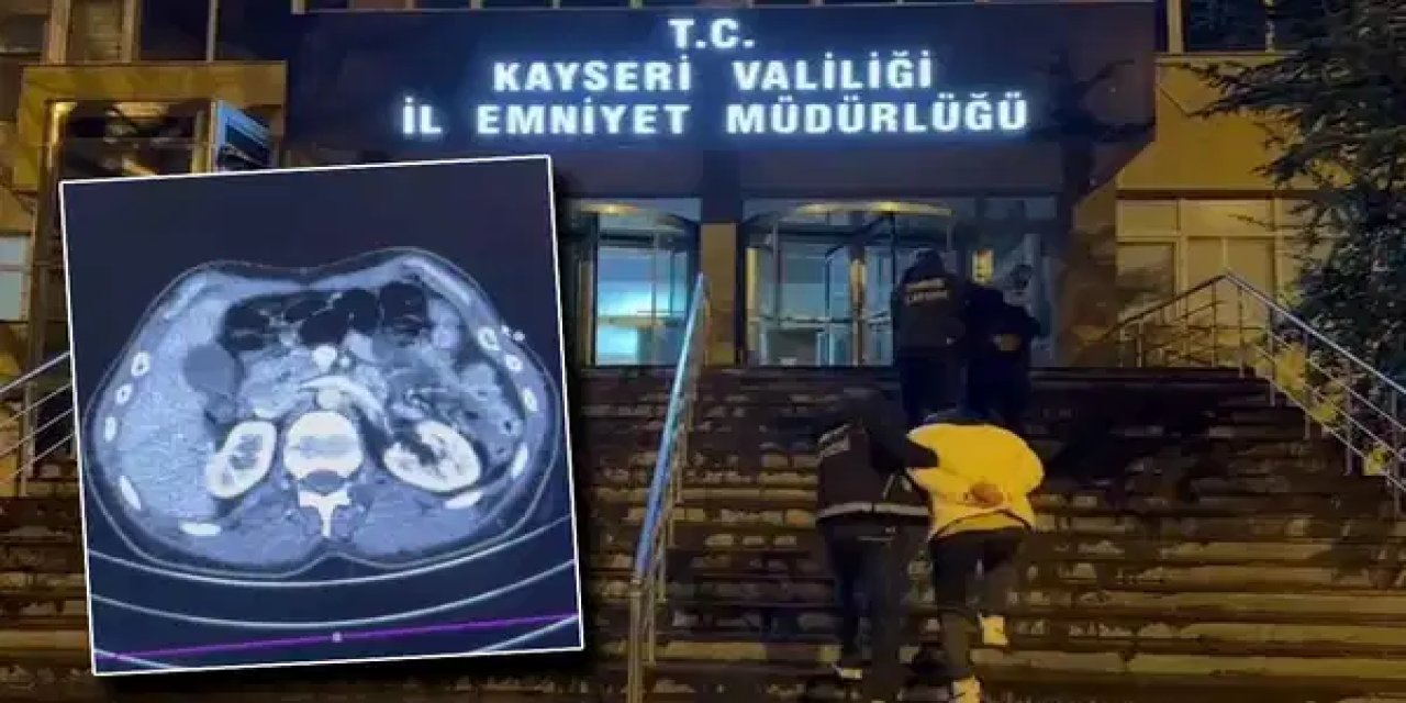 Kayseri'de operasyon: Midesinden uyuşturucu çıkan 3 İranlı gözaltında