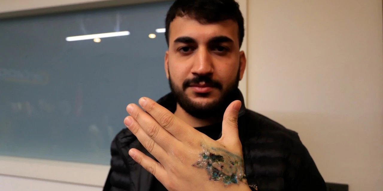 Dövme sildirmek isterken kabusu yaşadı, elindeki dokular öldü