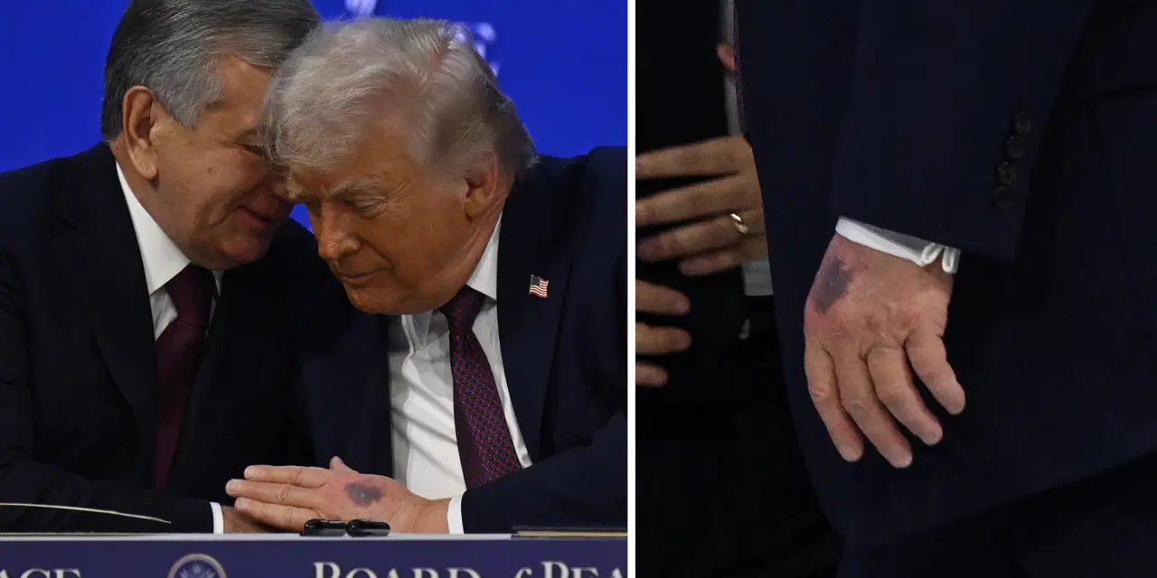 Trump'ın elindeki morluğun nedeni belli oldu