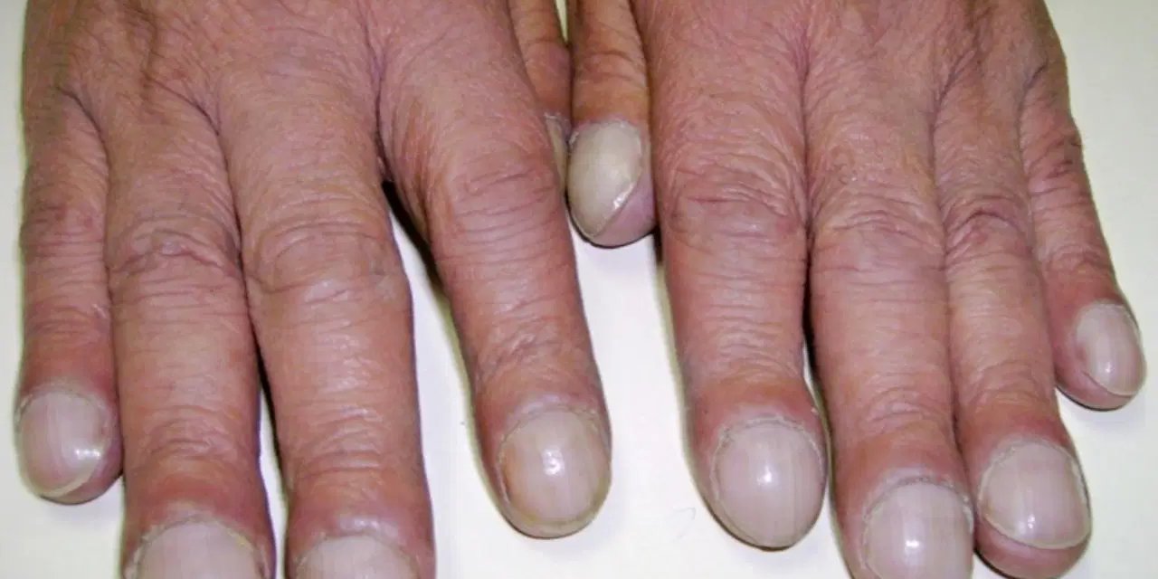 Tırnaklarınız ipucu veriyor olabilir: Akciğer kanserinde “çomak parmak” belirtisi