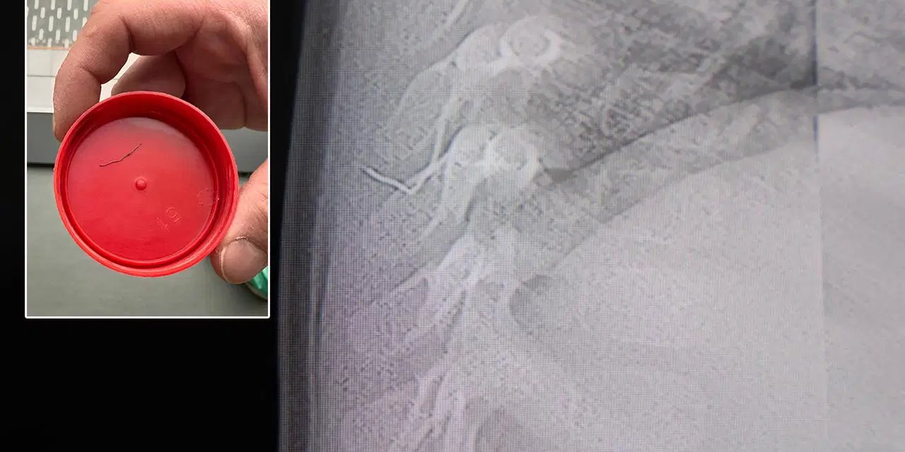 '8 yaşına kadar bekleyin' dediler: Bebeğin akciğerinden çıkan cisim şaşırttı!