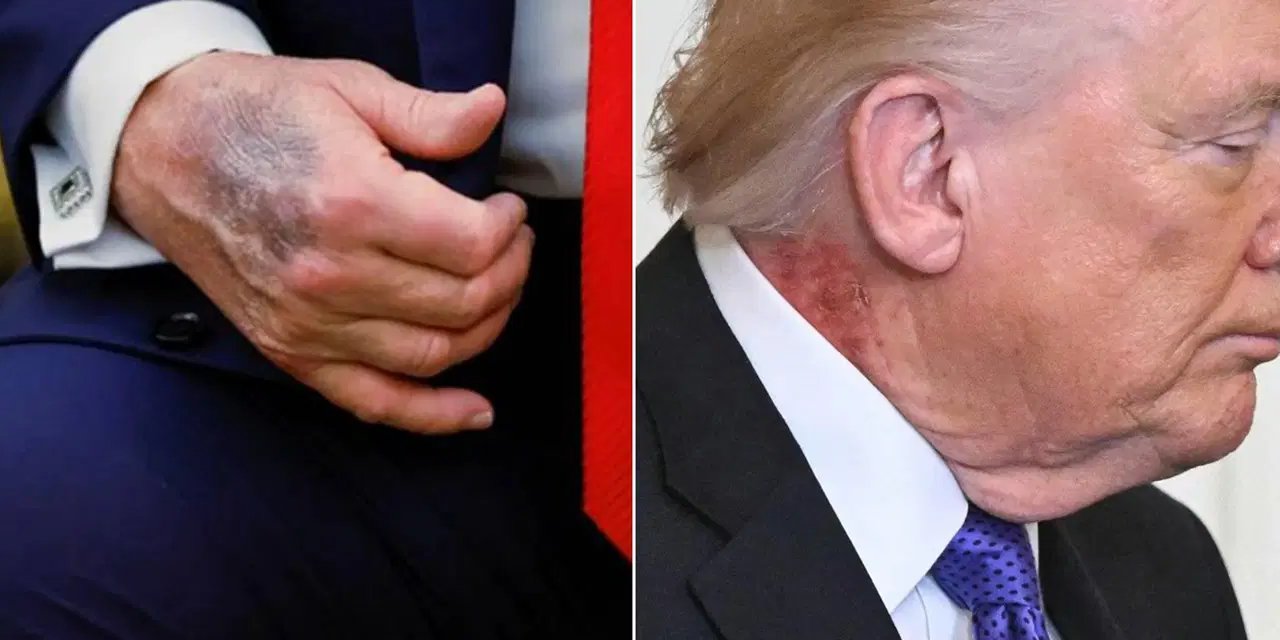 Morluğun ardından kızarıklık... Trump'ın doktorundan açıklama geldi