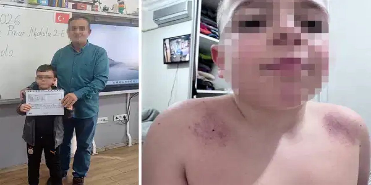 İlkokulda darp skandalı: 2. sınıf öğrencisinin omuzları morluklar içinde kaldı!