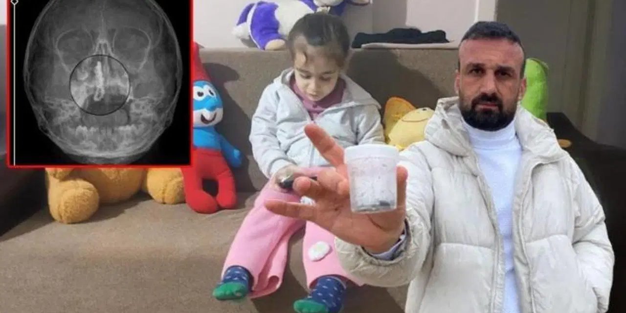 5 yaşındaki Polen'in burnundan tırnak makası zinciri çıktı!