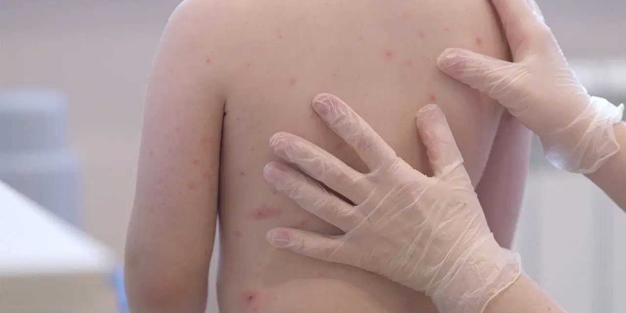 Kızamıkta 'sinsi' tehlike: Sadece döküntü değil, yıllar sonra gelen ölümcül riske dikkat!