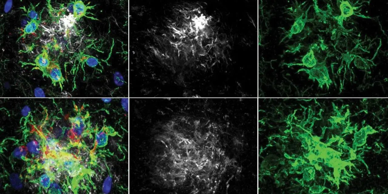 Alzheimer tedavisinde yeni ufuk: Beynin 'temizlik ekibi' yeniden programlandı