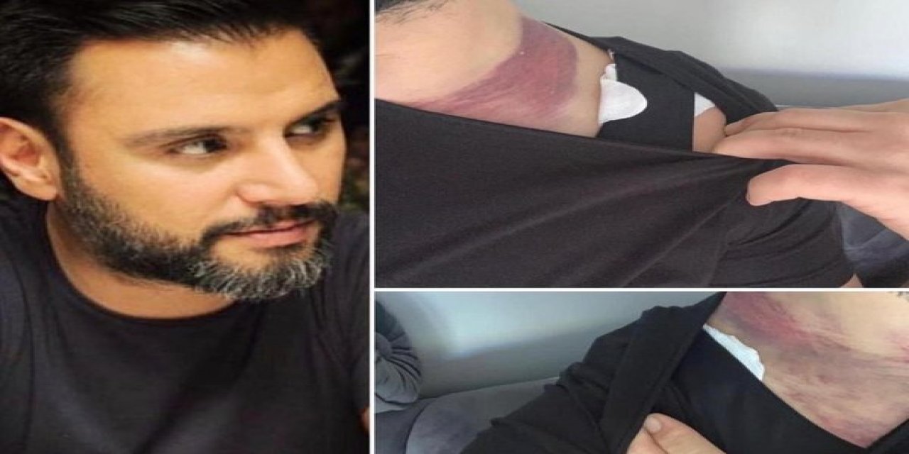 Liposuction sonrası ölümden döndüğünü bu fotoğraflarla duyurmuştu... Alişan’dan doktora 2 milyonluk dava!