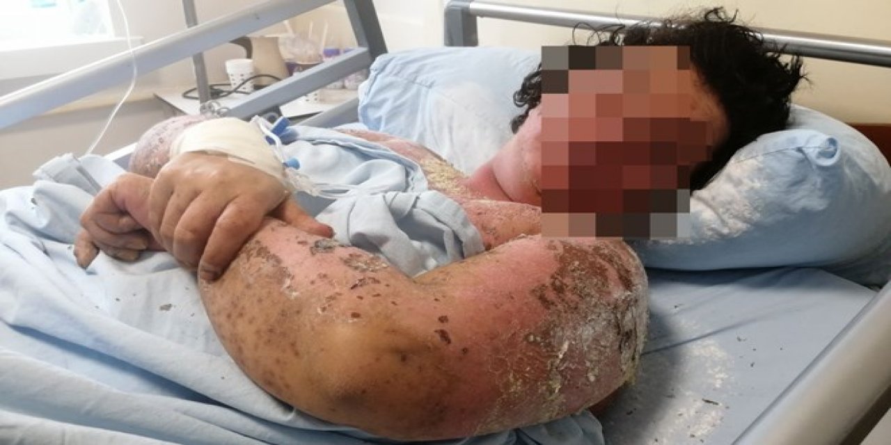 Yanlış antibiyotik hayatını zindana çevirdi!