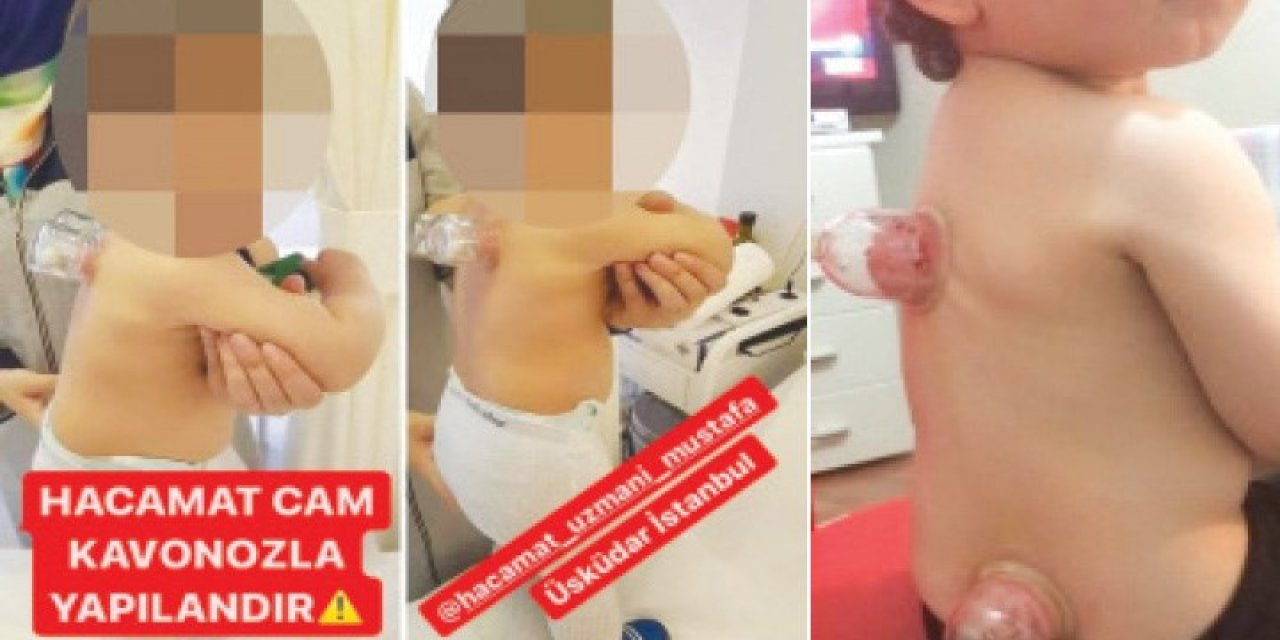 Bebeklere hacamat yapıyorlar! "Bu fiziksel bir istismardır"