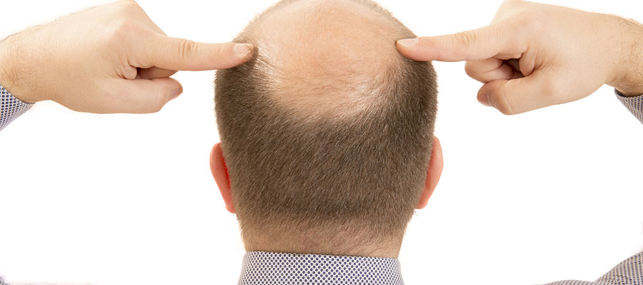 Koronavirüs kel mi yapıyor?