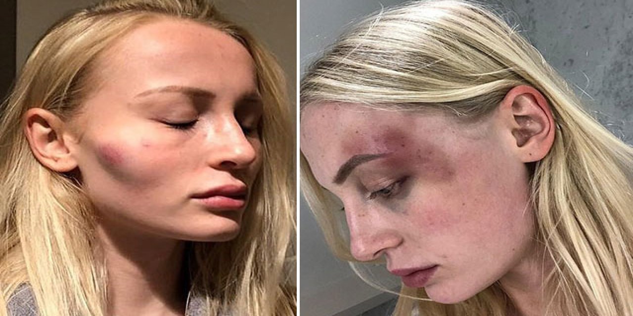 Dünyaca ünlü model dayağı fotoğraflarla belgeledi!