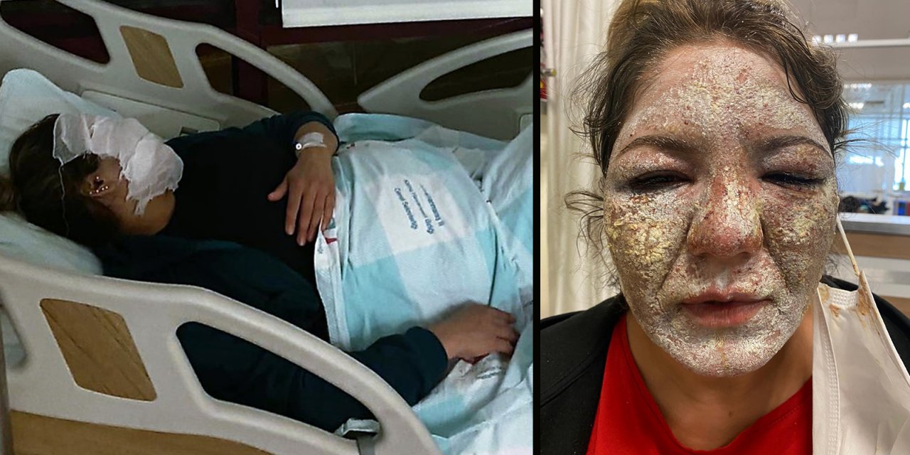 Güzellik merkezinde dehşeti yaşadı! "Cildin bebek gibi olacak" demişlerdi ama hastanelik oldu!