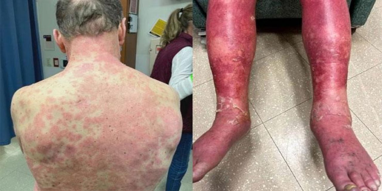 Korona aşısında "yan etki" kabusu! Johnson&Johnson aşısını olduktan 4 gün sonra bu hale geldi!