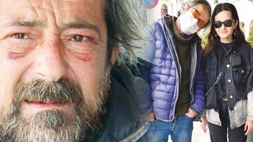 Göz altındaki morluklarla dikkat çekti... Feridun Düzağaç: Dayak yedim!