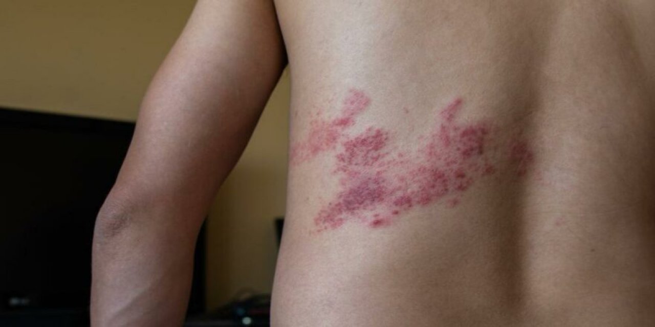 "Aşıdan sonra zona oldular" Pfizer-BioNTech aşısında yan etki endişesi!