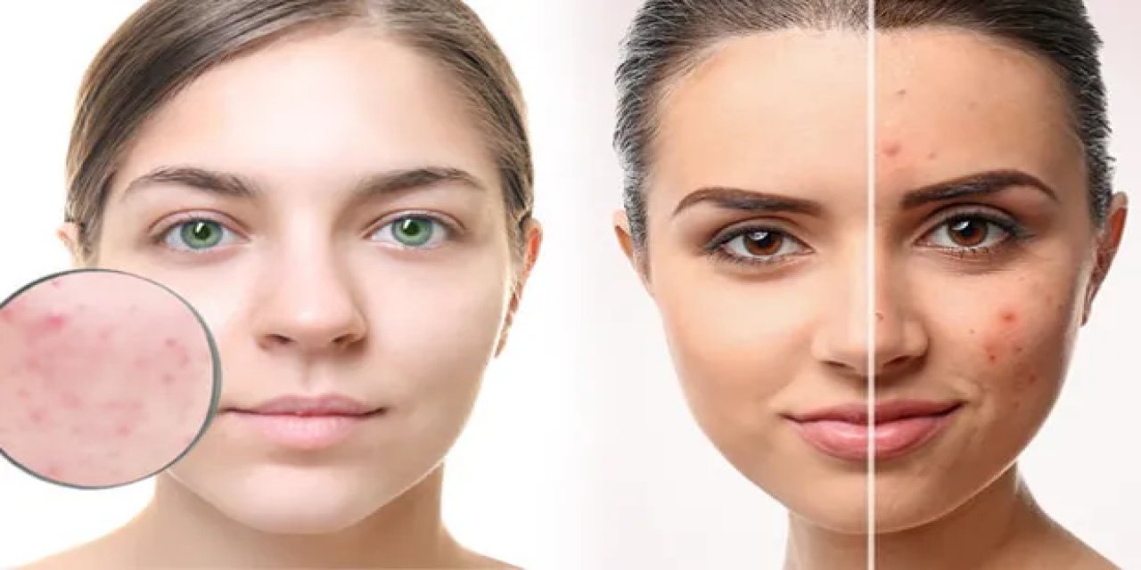 “Sivilcelerinizden kurtulmanın yolu bitkilerde saklı”