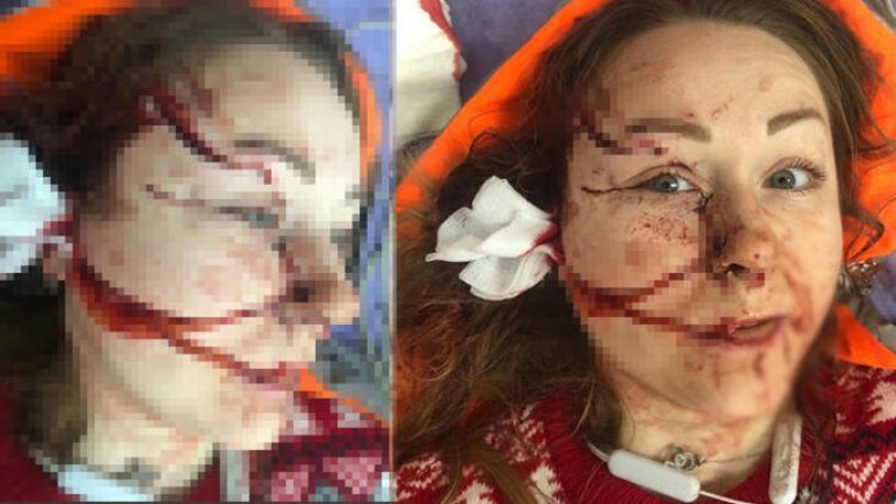 Boşanmak istediği erkeğin falçatalı saldırısına uğradı! Ukraynalı Hanna: Artık kimseye güvenmiyorum