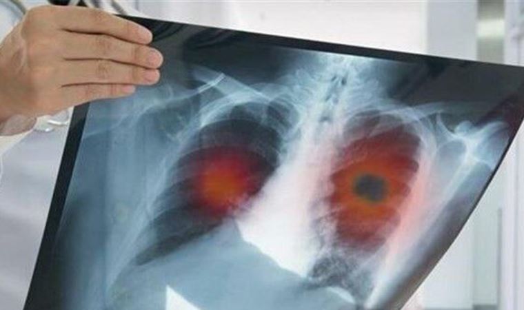 Prof. Dr. Murat Servan Döşoğlu açıkladı! Salgın döneminde osteoporotik kırıklar artış gösterdi