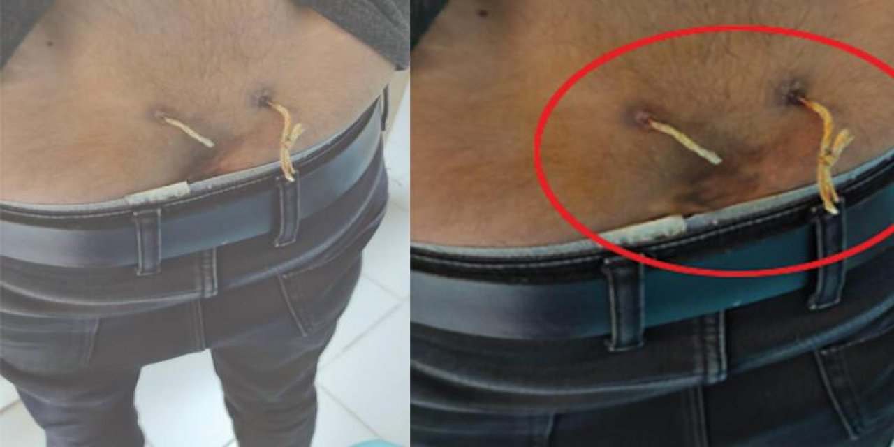 Akılalmaz olay! "Alternatif tıp" adı altında işkence! Hastayı muayene eden doktor bu manzarayla karşılaştı! Beline iki delik açtılar ve...