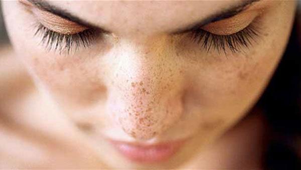 Uzmanından uyarı! Güneş ışınları bazı hastalıklara davetiye çıkarıyor