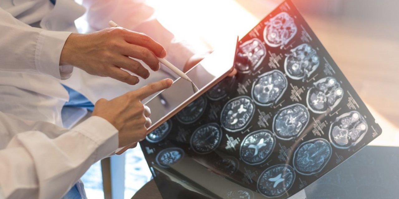 Felç hastalarında belirtiler 10 yıl önce ortaya çıkıyor... Peki hangi gruplar daha yüksek risk altında? İşte ayrıntılar...