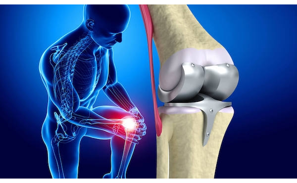 İşte diz protezi ameliyatına dair her şey
