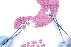 Op. Dr. Özel açıkladı! İşte mide botoksu ile ilgili bilinmesi gerekenler