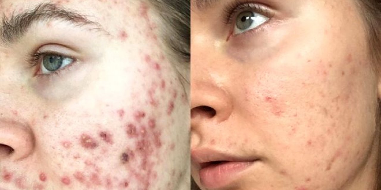 Yerken çok dikkat edin... O çok sevdiği besin suratını tanınmaz hale getirdi!