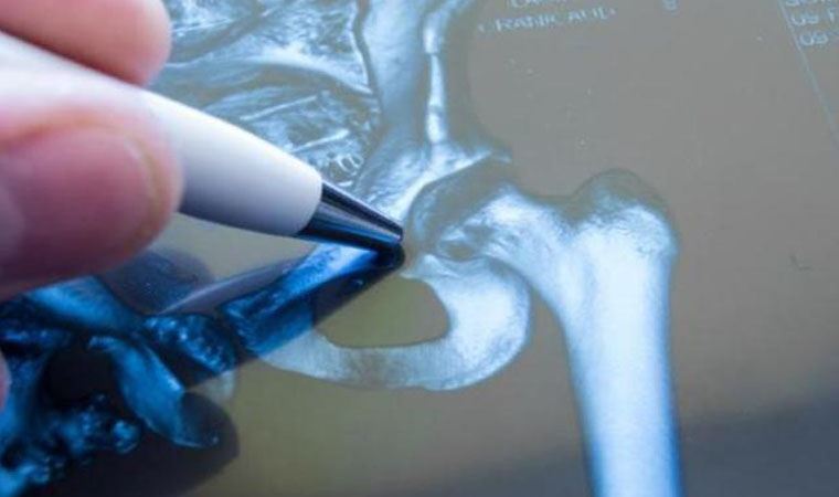 Kalça kırıklarını, 15 günde iyileştiren yerli implant geliştirdi
