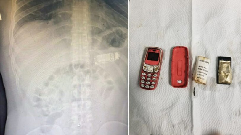 Dünya bu olayı konuşuyor! Midesinden Nokia 3310 çıktı