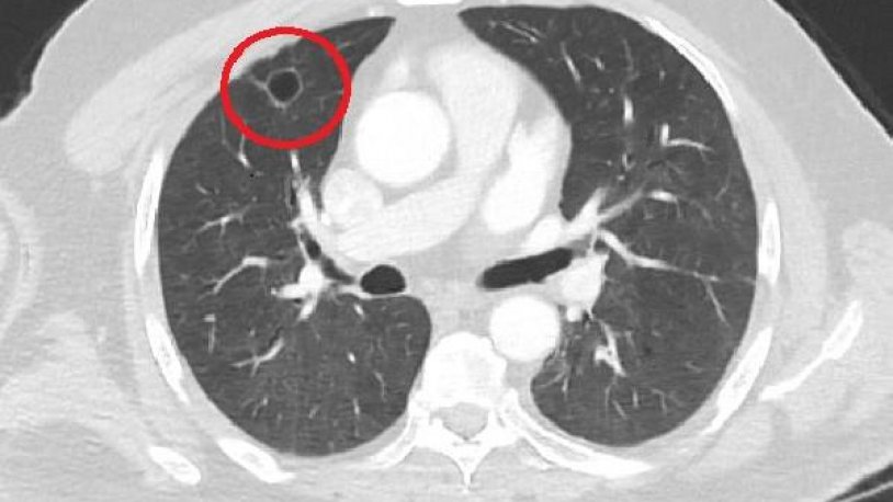 Dünya tıp literatüründe bir ilk! Türkiye'de tespit edildi