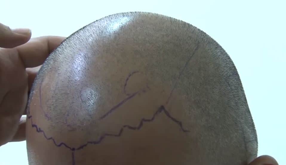 İbrahim Gül'ün saç ekimi sırasında hayatını kaybetmesi infial yarattı! Saç ekim merkezleri hakkında korkutan iddia