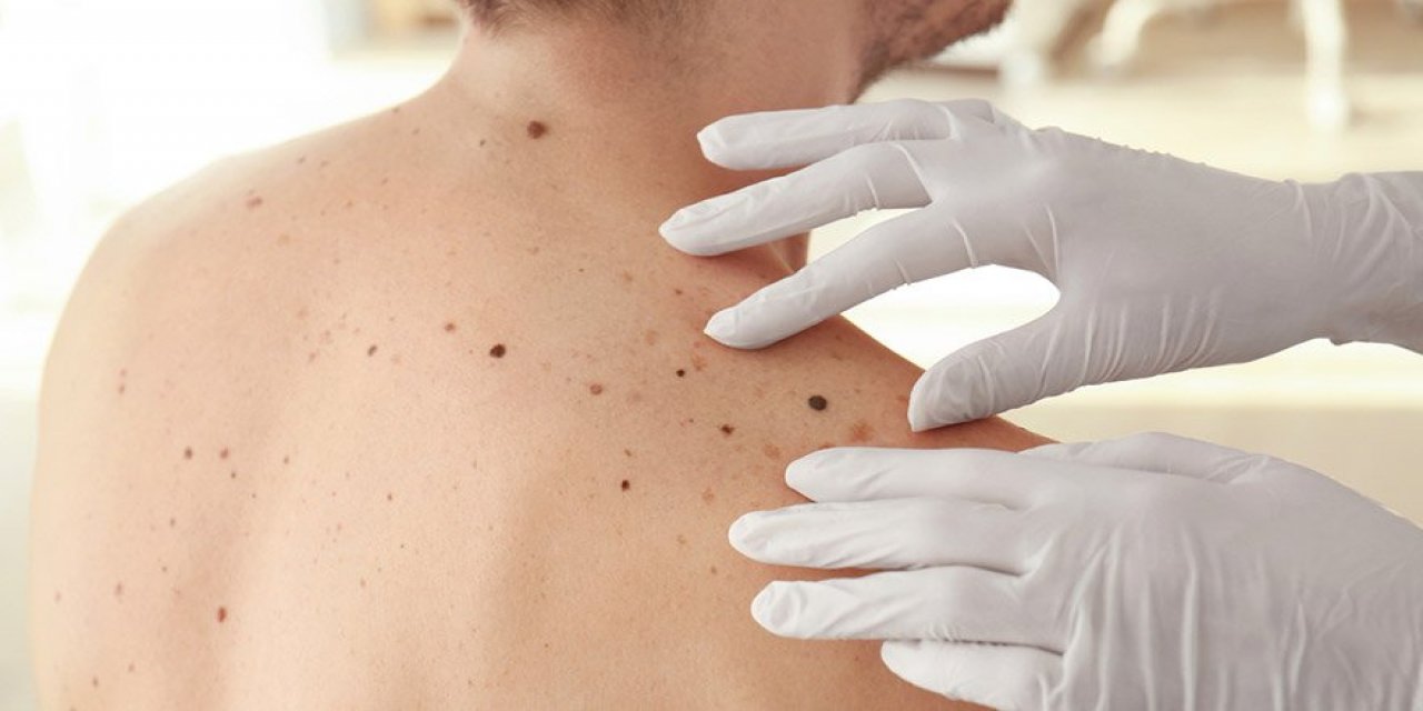 Deride ortaya çıkan benlere dikkat! Hangi durumlarda kanser riski fazla?