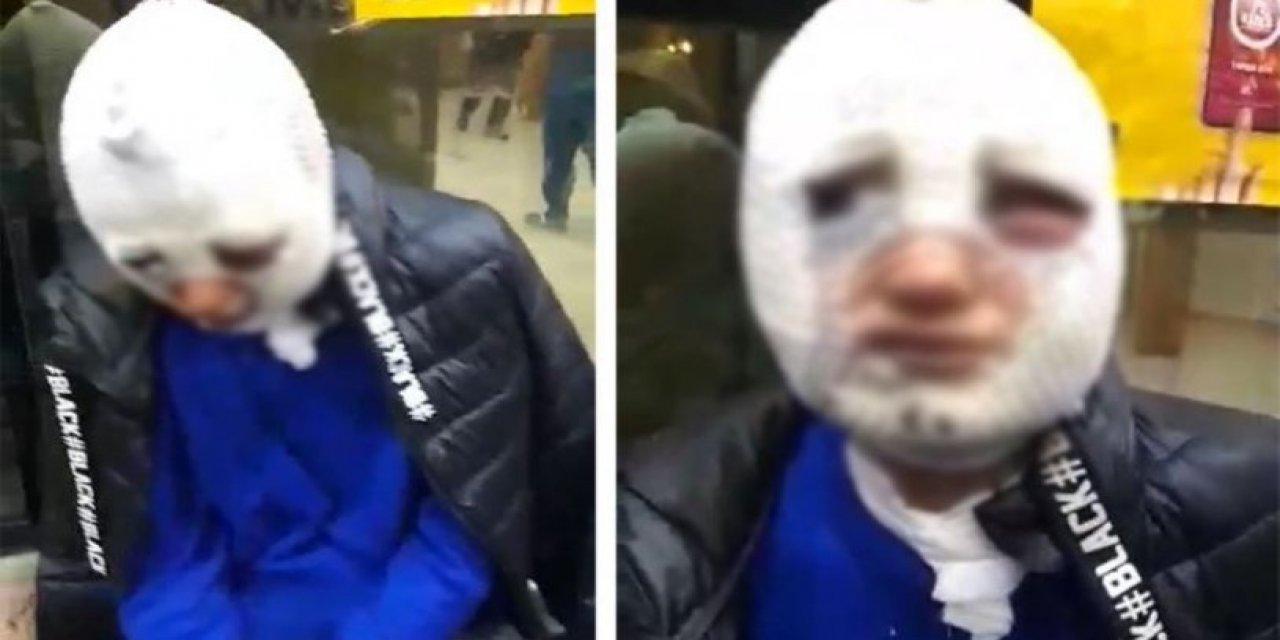 Hatay'da erkek şiddeti: Dövdü, cinsel saldırıda bulunup kızgın yağ ile yaktı!