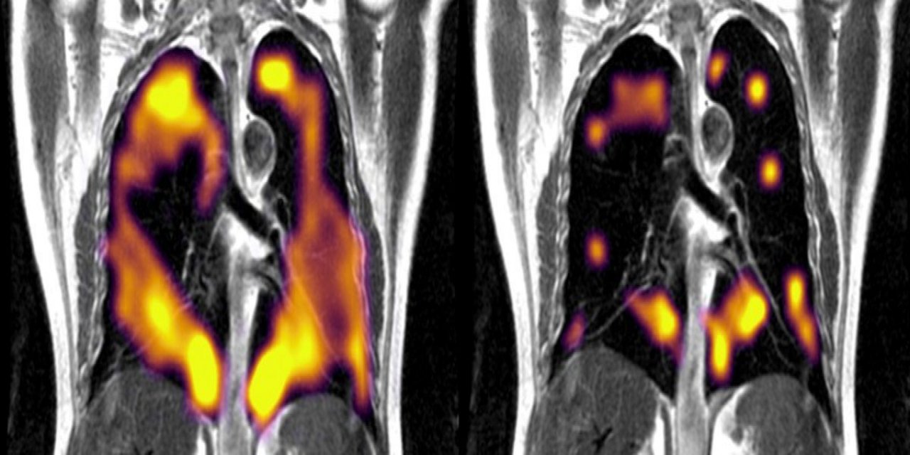 Covid-19’u hafif geçirenlerin akciğerlerindeki gizli hasar ortaya çıktı