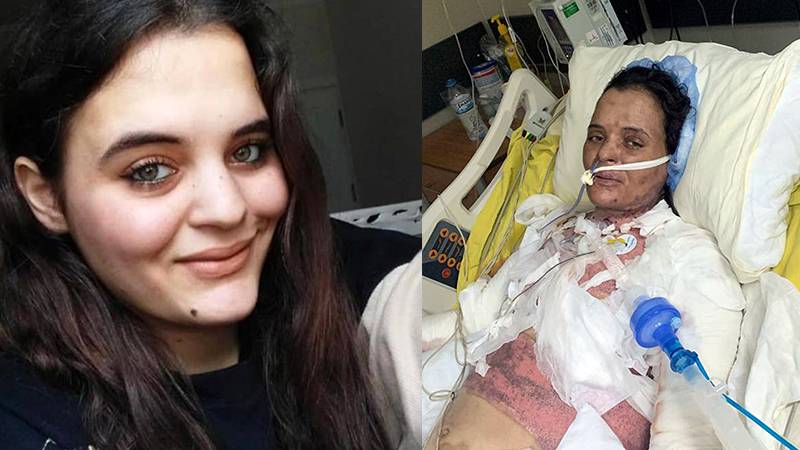 Dezenfektanın patlamasıyla yanan Havva Öz, 75 gündür yoğun bakımda