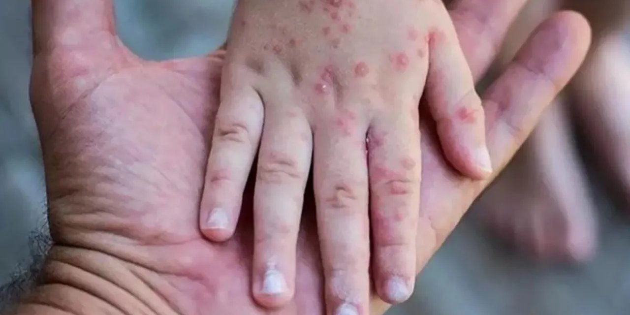 Maymun Çiçeği'nde son durum: 73 bin 437 toplam vaka, 29 kişi hayatını kaybetti