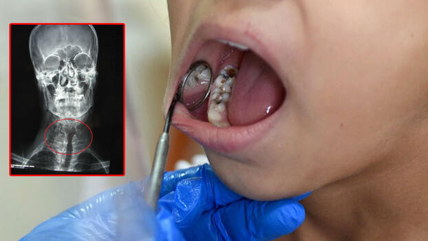 Tedavi edilmeyen diş iltihabında ölümcül "mediastinit" riski uyarısı: