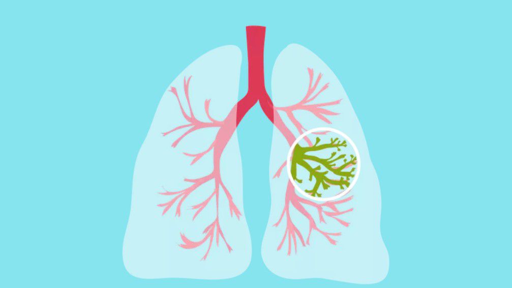Kistik Fibrozis nedir, belirtileri neler?
