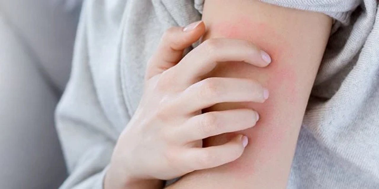 Sağlık Bakanlığı’ndan uyuz uyarısı