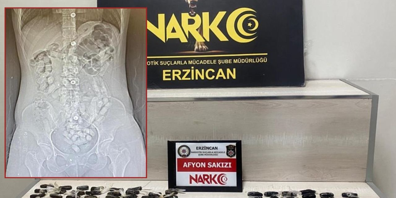 İranlı 2 kadının midelerinden 95 parça halinde 693,3 gram Afyon sakızı çıktı