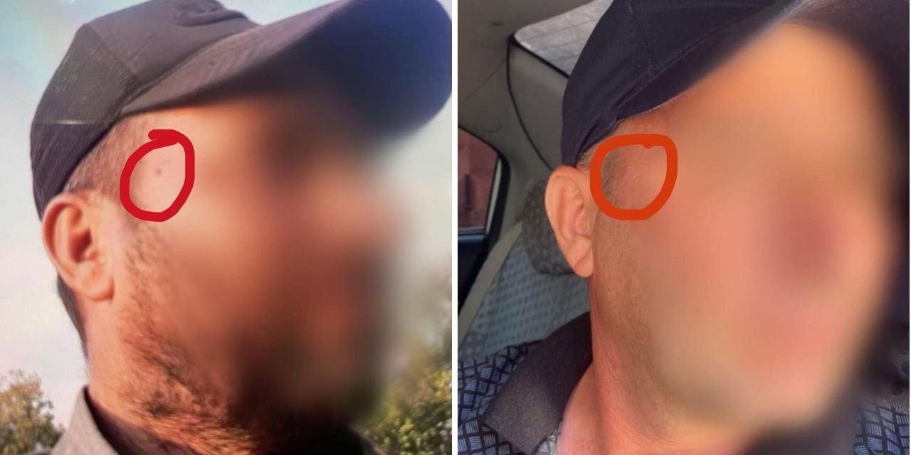Şüphelilerden birinin sağ şakağında ben olduğu bilgisine ulaşıldı... Benin fark edildiğini öğrenip, kısa süre önce aldırdı