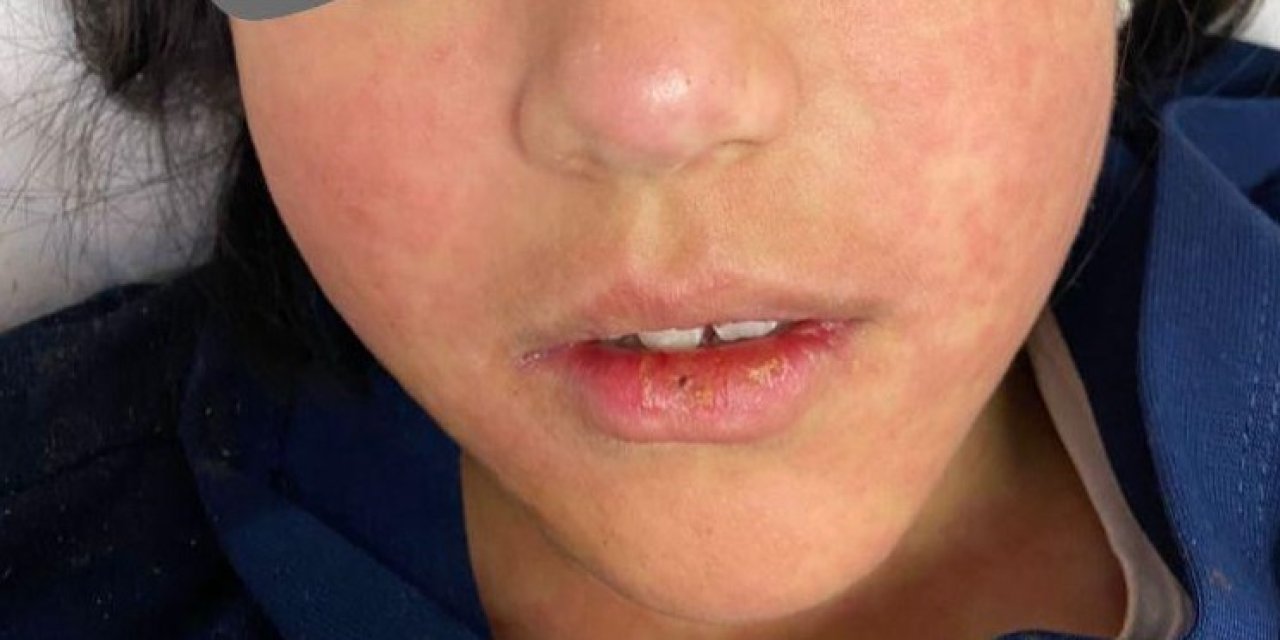 Kızamık uyarıları devam ediyor: Aşılamada yüzde 95 altına inildiği zaman salgın riski başlar